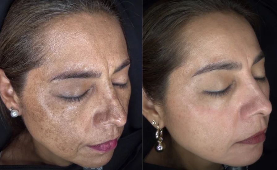 Láser para Manchas (Q-Switched / IPL)